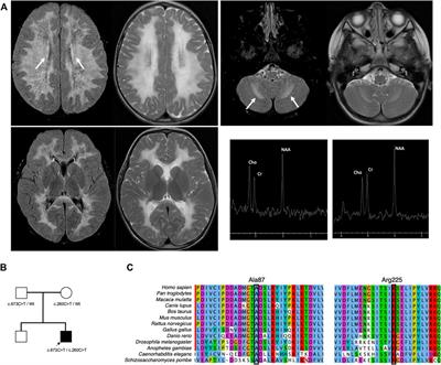 Case Report: A Novel EIF2B3 Pathogenic Variant in Central Nervous System Hypomyelination/Vanishing White Matter